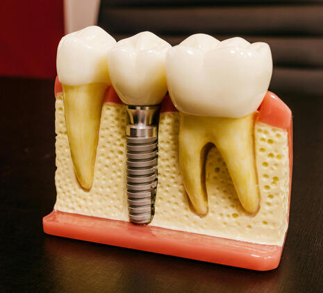 Implants dentaires cabinet dentaire du Dr Barthélemy à Strasbourg Cronenbourg