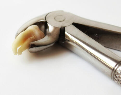 extraction dents de sagesse